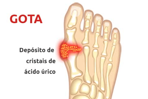 Gota - S.O.S Medicos - Taviclinica